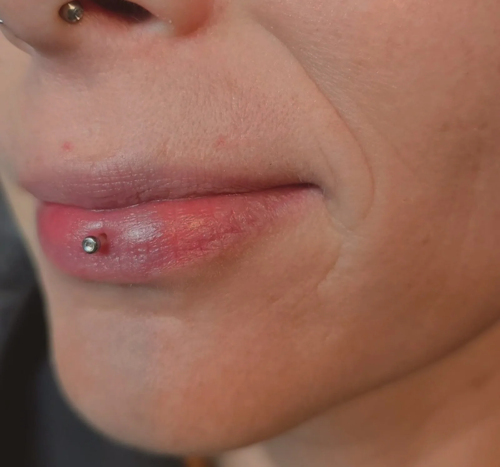 Piercinglochentfernung – Beispiel 3