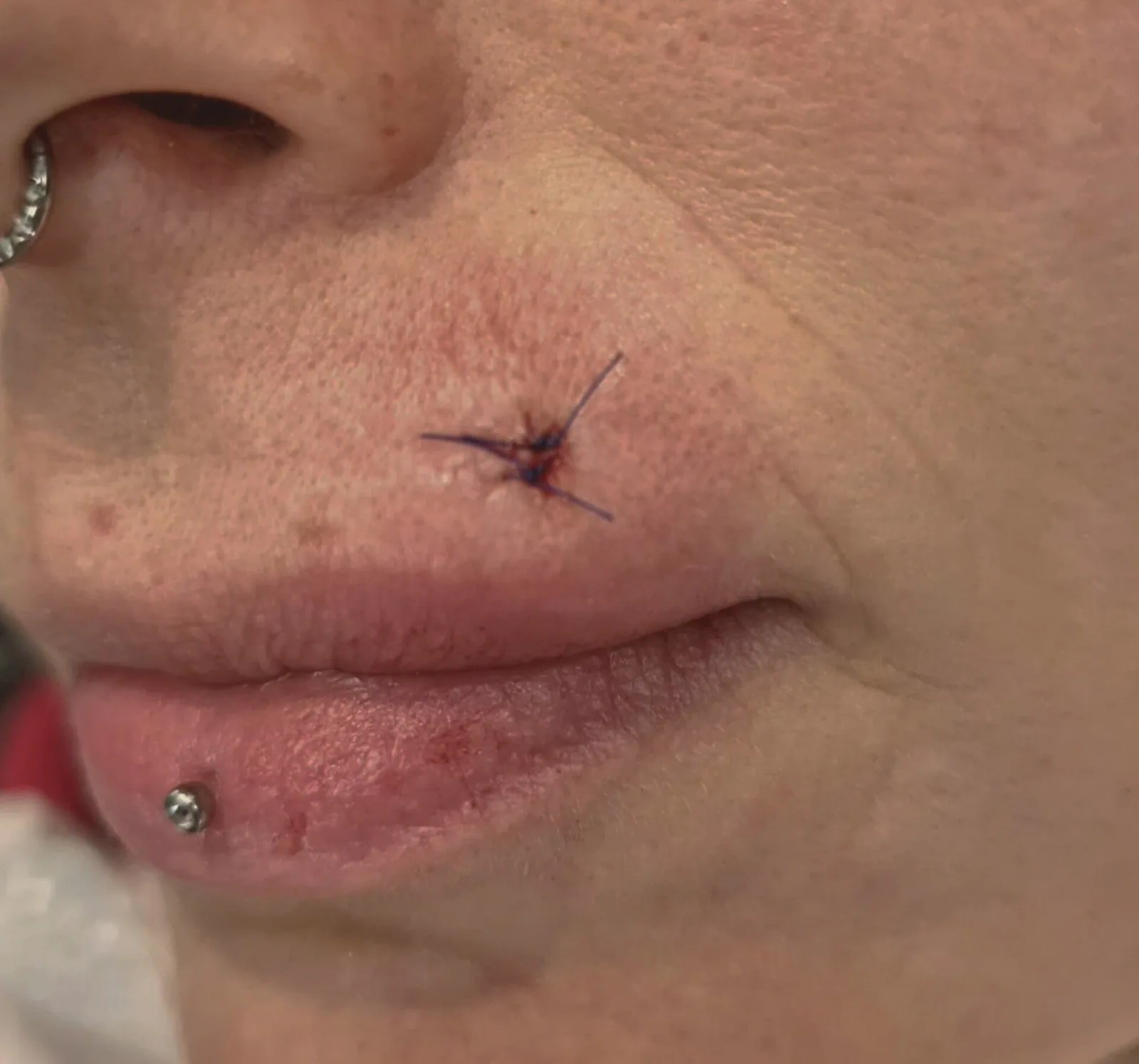 Piercinglochentfernung – Beispiel 2