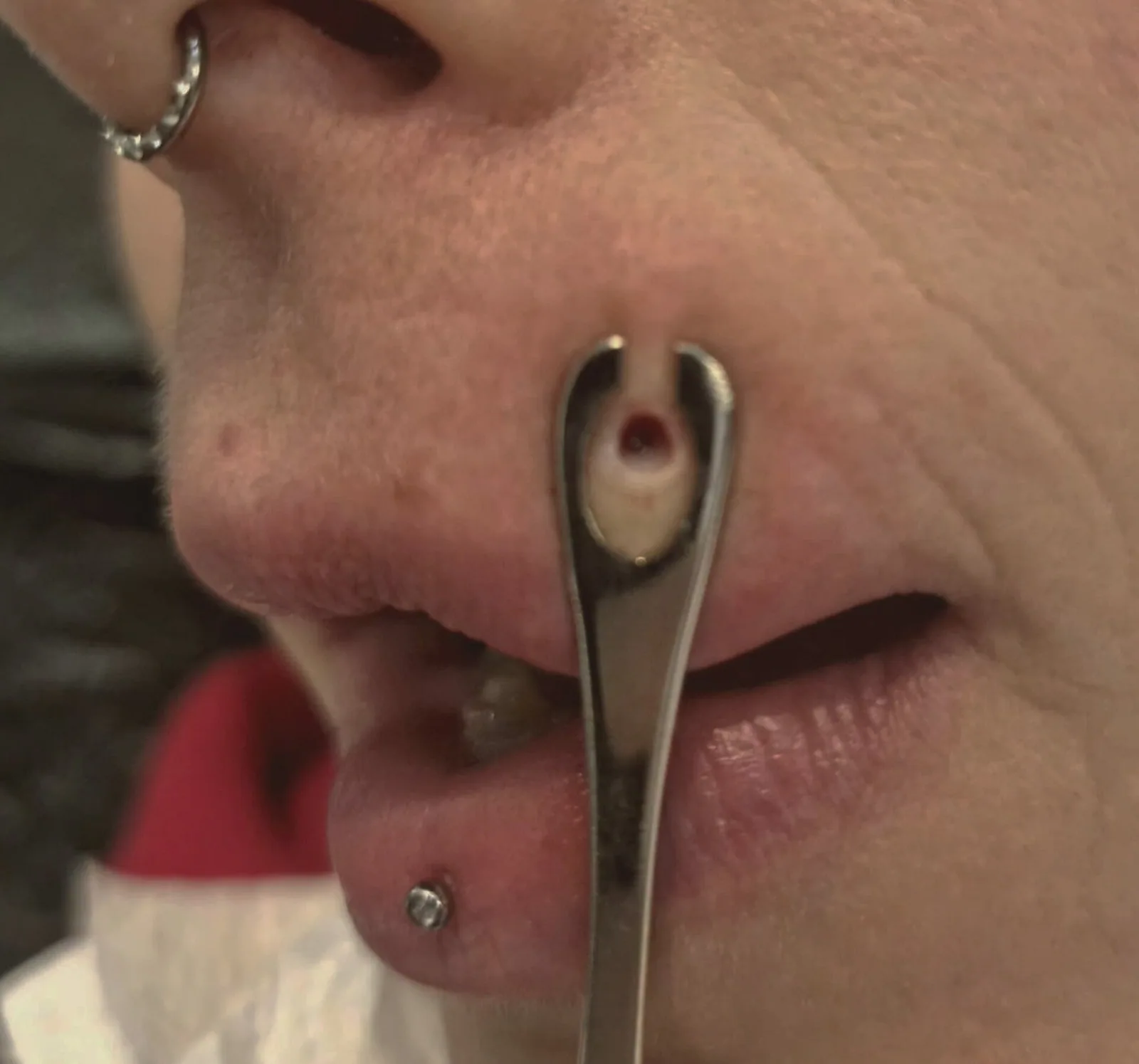 Piercinglochentfernung – Beispiel 1