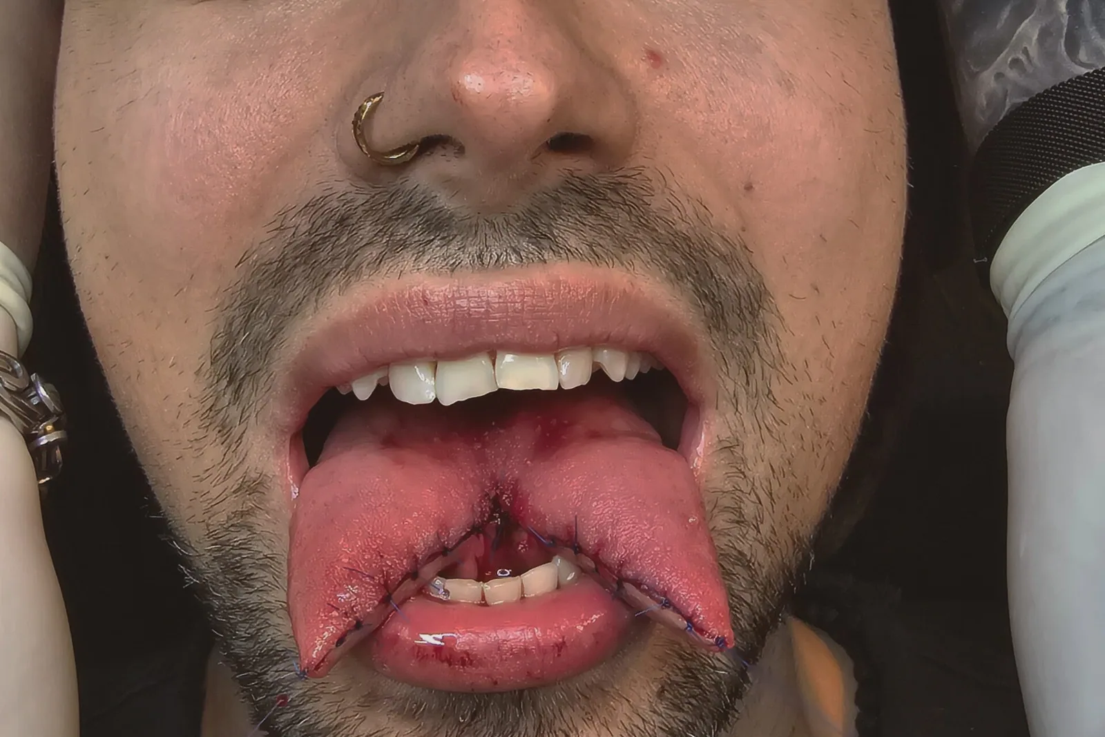 Zungenspaltung / Tonguesplitting – Beispiel 2