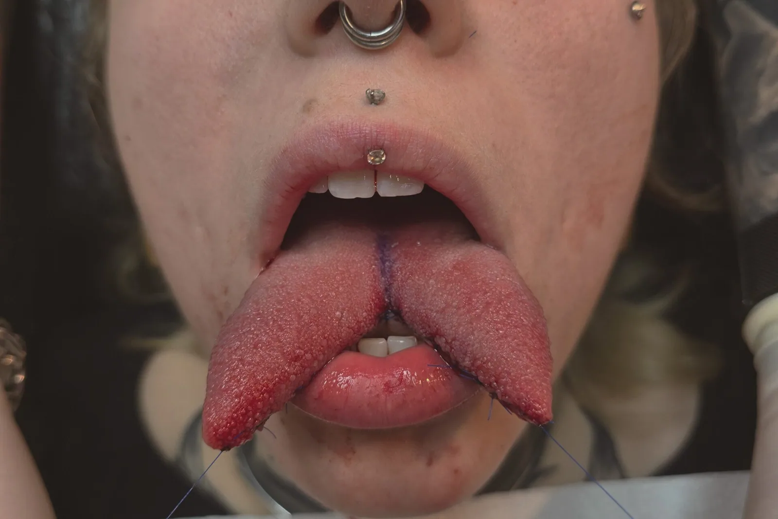 Zungenspaltung / Tonguesplitting – Beispiel 4